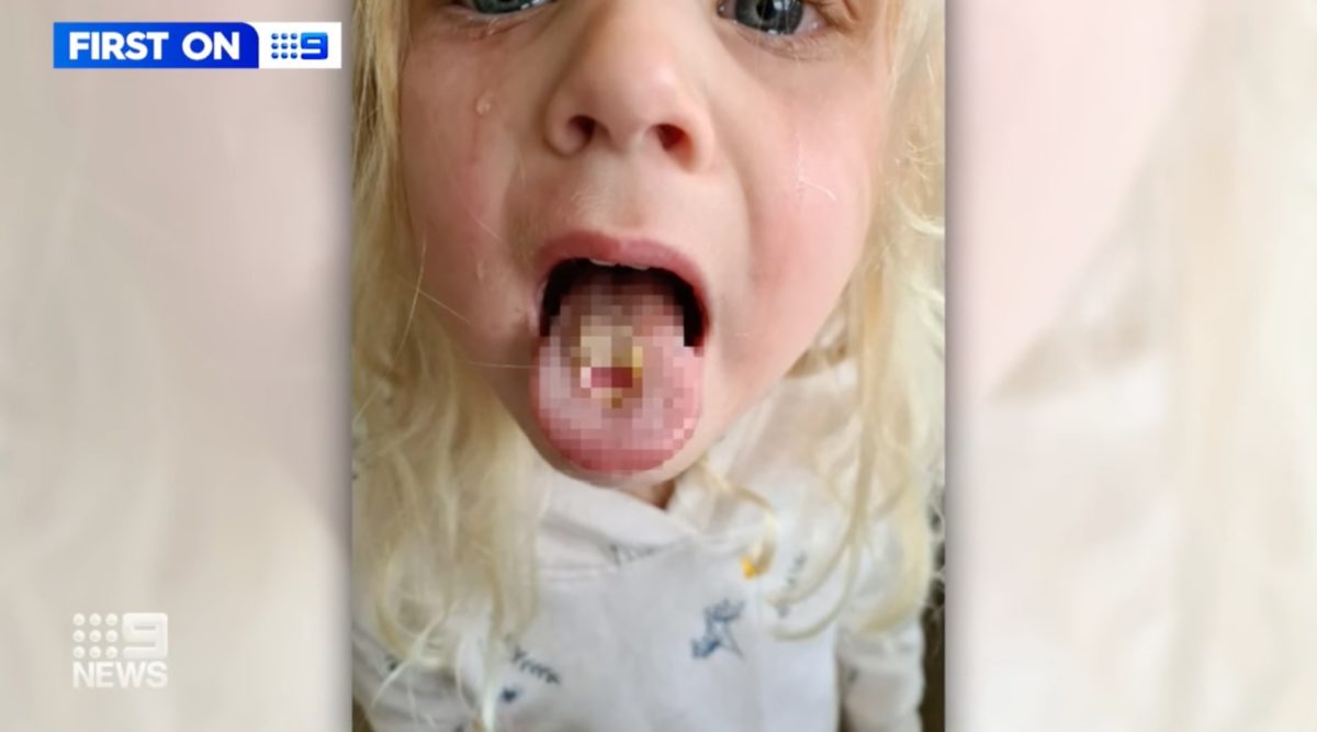 4-year-old vows to never eat sour warheads again after they left her in serious pain